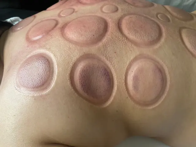 Upper-back cupping response