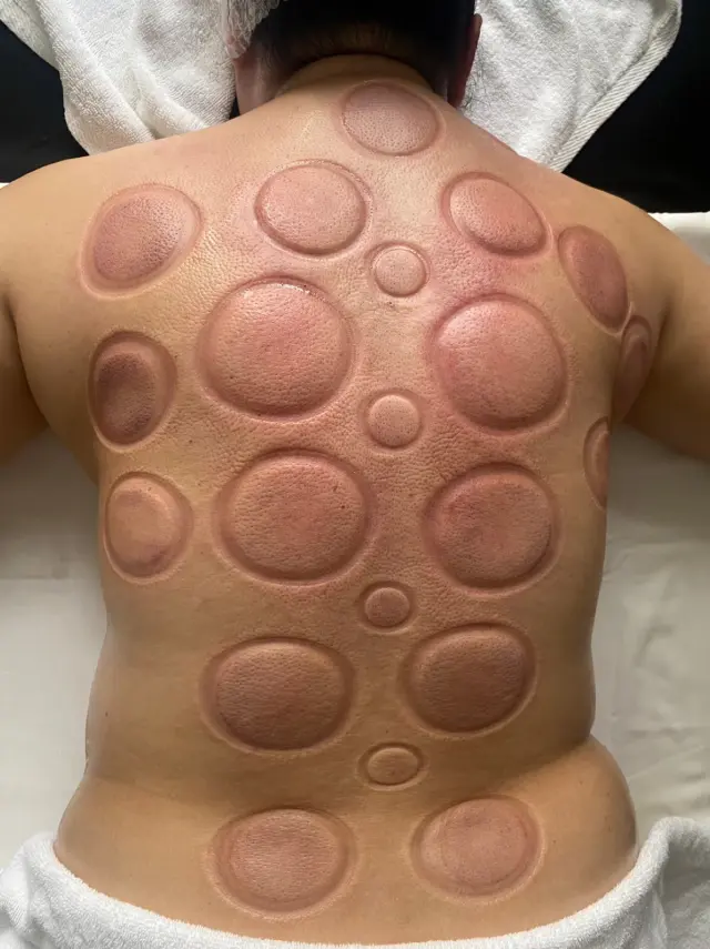 Back assessment after cupping