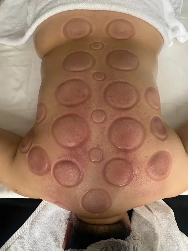 Full back cupping pattern